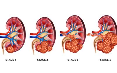 Kidney Cancer Management